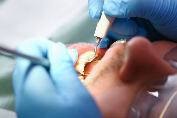 Best Knocked-Out Tooth (Avulsed Tooth) Treatment in Shelbyville, IN