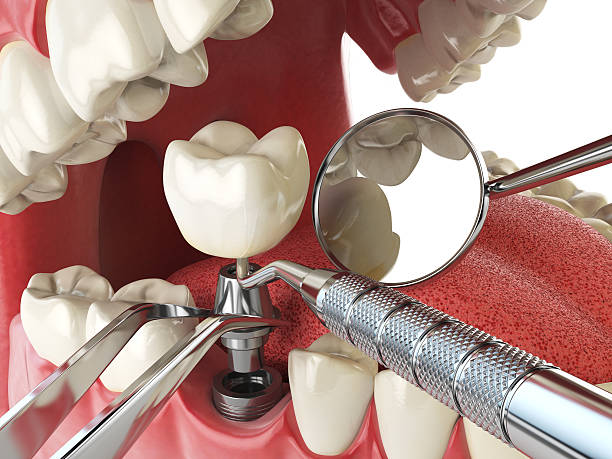 Best Emergency Dental Care for Sports Injuries in Shelbyville, IN
