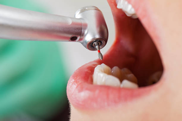 Best Broken or Chipped Tooth Repair in Shelbyville, IN